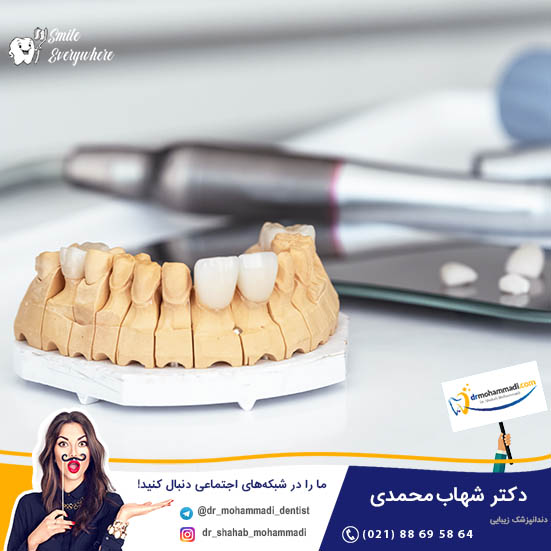 روکش دندان چیست؟  - کلینیک دندانپزشکی دکتر شهاب محمدی